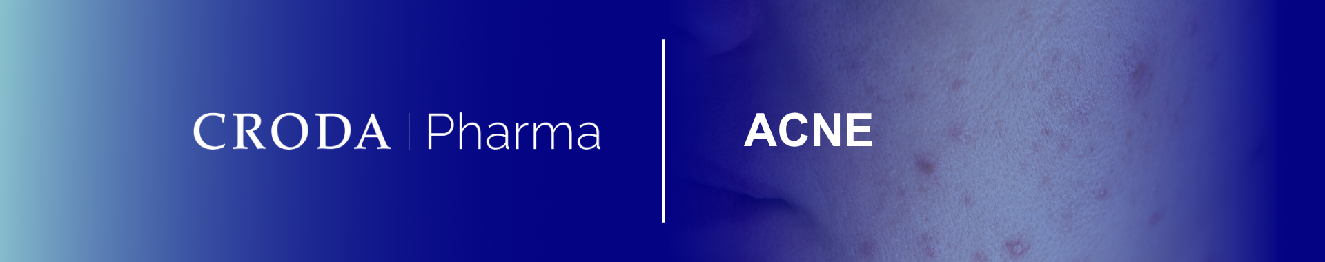    Formulating acne products requires light, non-occlusive ingredients to soothe inflamed skin, optimise the performance of anti-acne actives and encourage repeat use of the product.