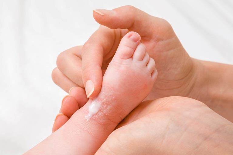 Mother carefully applying medical ointment
