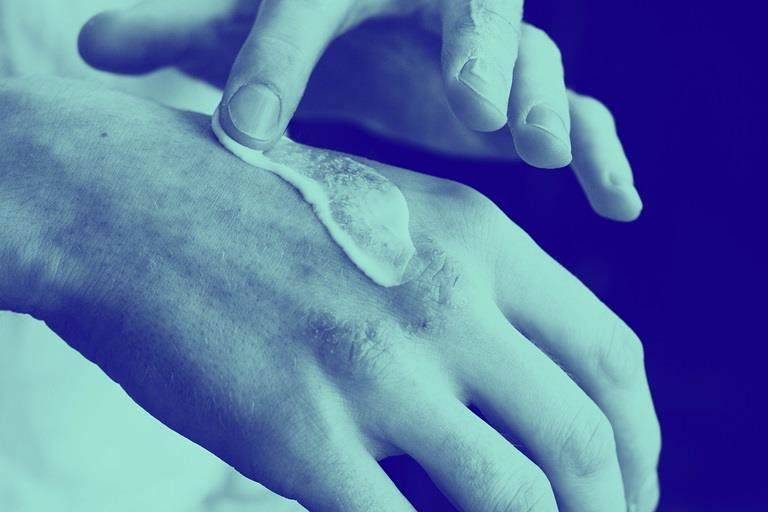 Eczema on the hands
