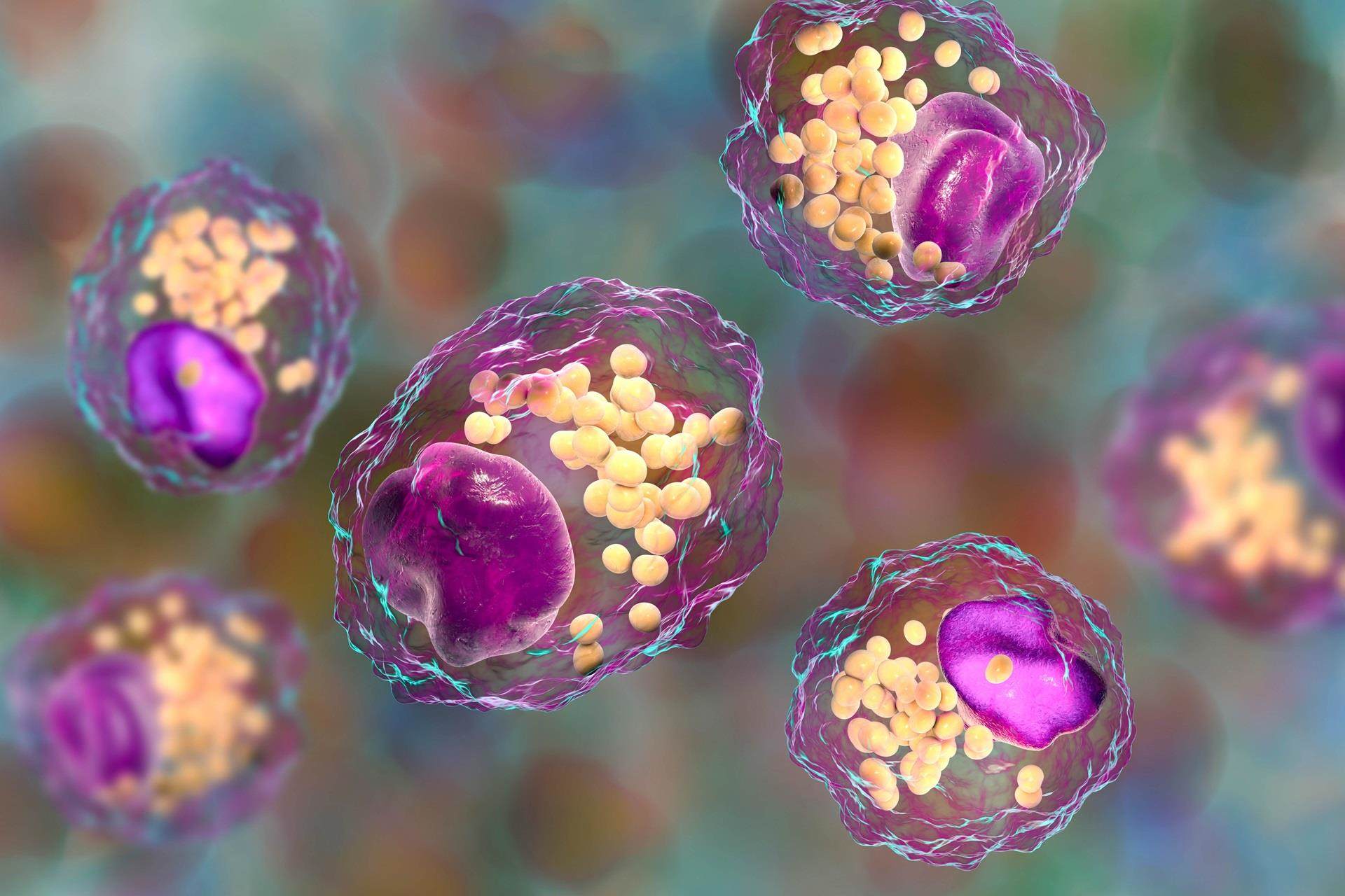 Foam cell, macrophage cells that contain lipid droplets and are components of atherosclerotic plaque