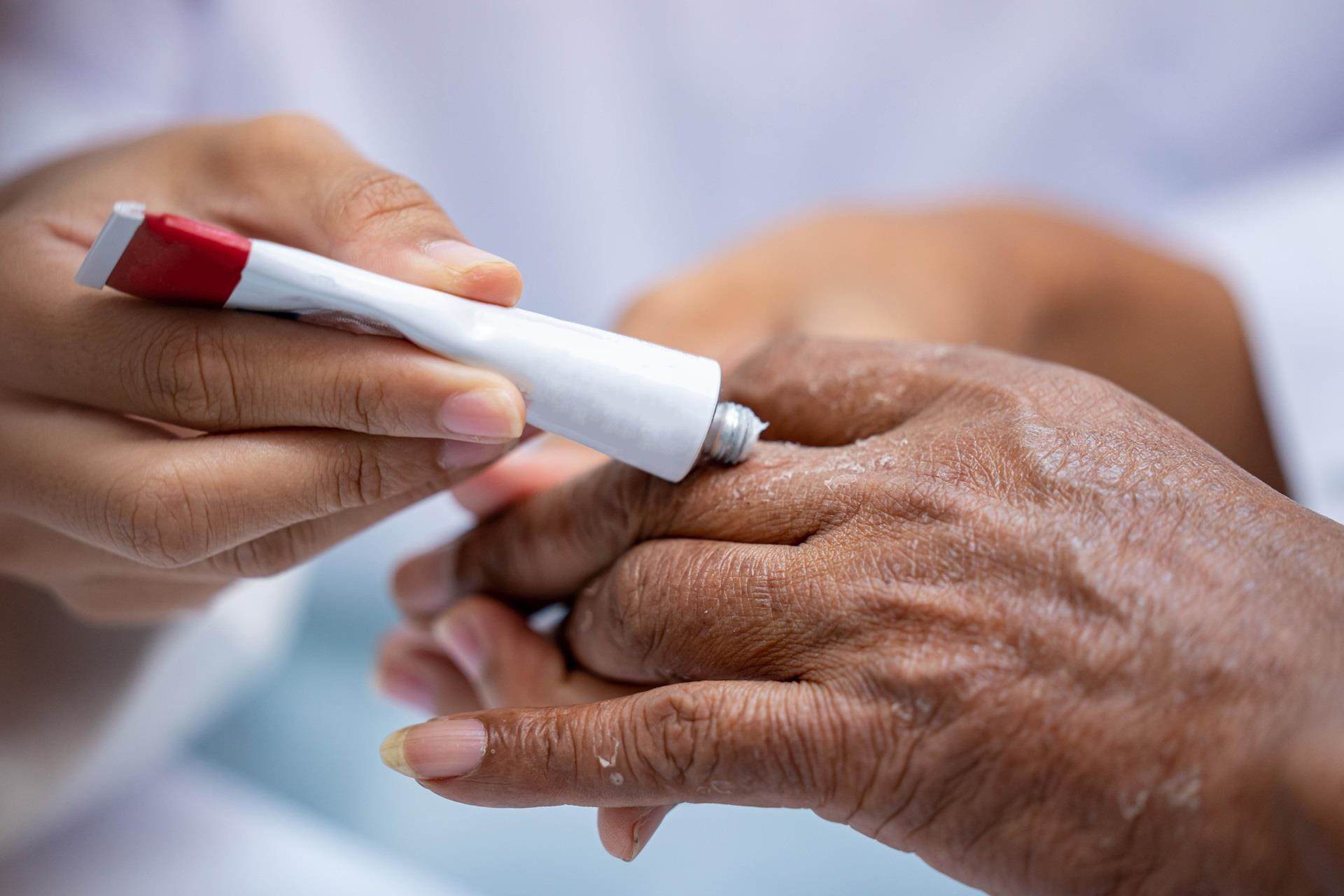 pharmacist or doctor hand apply steroid moisturizer cream on hand